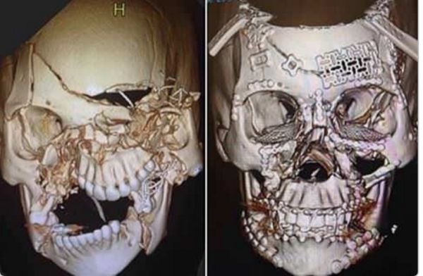 Хирург показа какво се случва с черепа при непоставен предпазен колан