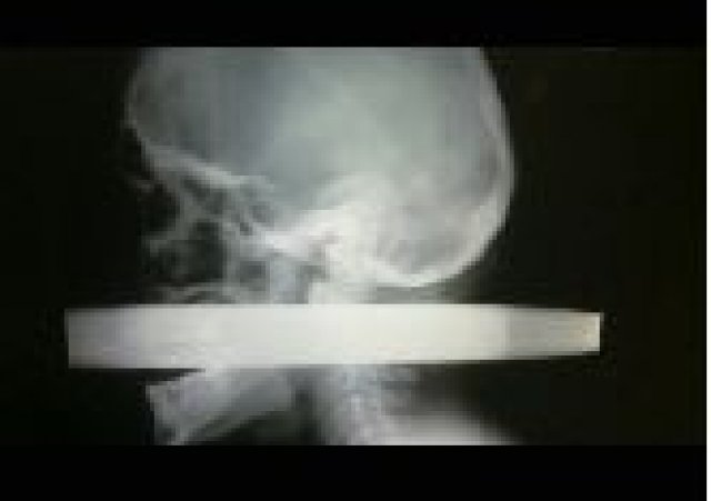 Да оцелееш с 15-сантиметрова тръба в главата