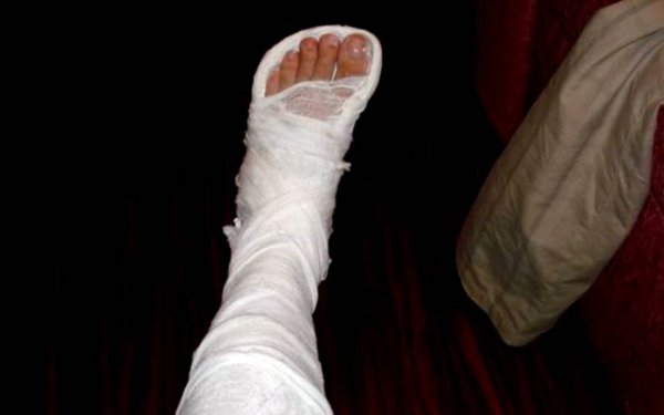 Според степента на увреждане изгарянията се делят на 4 степени. 1 и 2 степен се характеризират със зачервяване на кожата и появата на мехури. В такъв случай трябва да поставим изгорената повърхност под струя студена вода възможно най-скоро, да наложим чиста, суха превръзка и нещо студено върху нея.

При 3 и 4 степен се появяват участъци от овъглена кожа с обилно отделяне на кървава течност. Мястото на изгаряне трябва да се покрие със стерилна кърпа и да се приложи нещо студено отгоре. При обширни изгаряния е необходимо да се пие много вода.